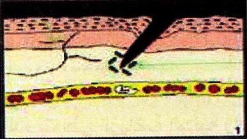 التعفن الجرثومي by aya - Ourboox.com