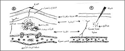 التعفن الجرثومي by malek - Illustrated by التعفن الجرثومي - Ourboox.com
