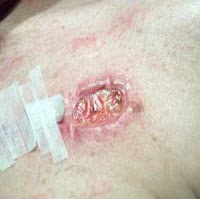 التعفن الجرثومي by malek - Illustrated by التعفن الجرثومي - Ourboox.com