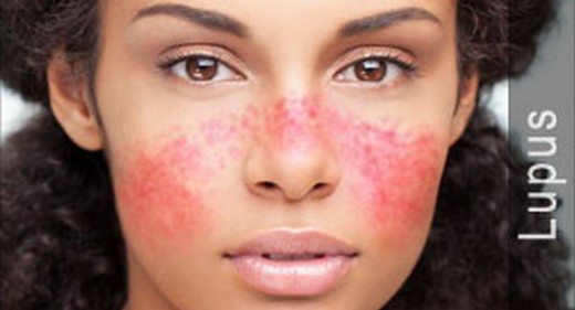 Nadir Hastalıklar by One Million Blue Ribbons - Ourboox.com