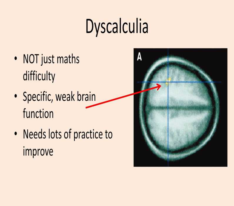 العسر الحسابي – ديسكلكوليا – Dyscalculia by sheren - Ourboox.com