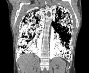 One million blue ribbons-Shejnaze Juka school-Shkoder-Albania by Etleva renci - Illustrated by Etleva Prenci - Ourboox.com