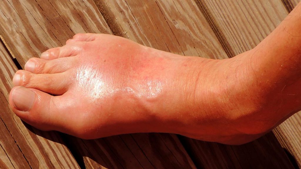 כיצד להירפא מגאוט במהירות by Alon - Ourboox.com