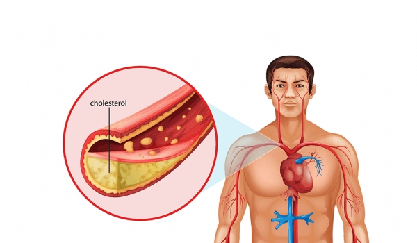 الكولسترول الضار وأمراض القلب by lamar - Ourboox.com
