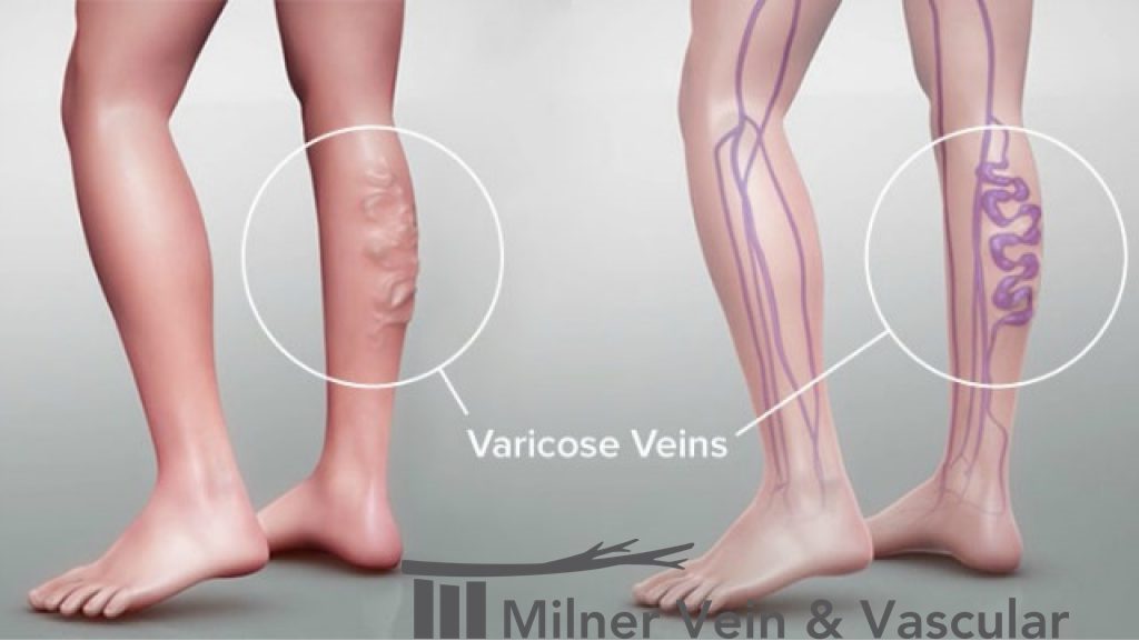 Best Varicose Vein Clinic in Lithonia, USA by Milner Vein and Vascular - Ourboox.com