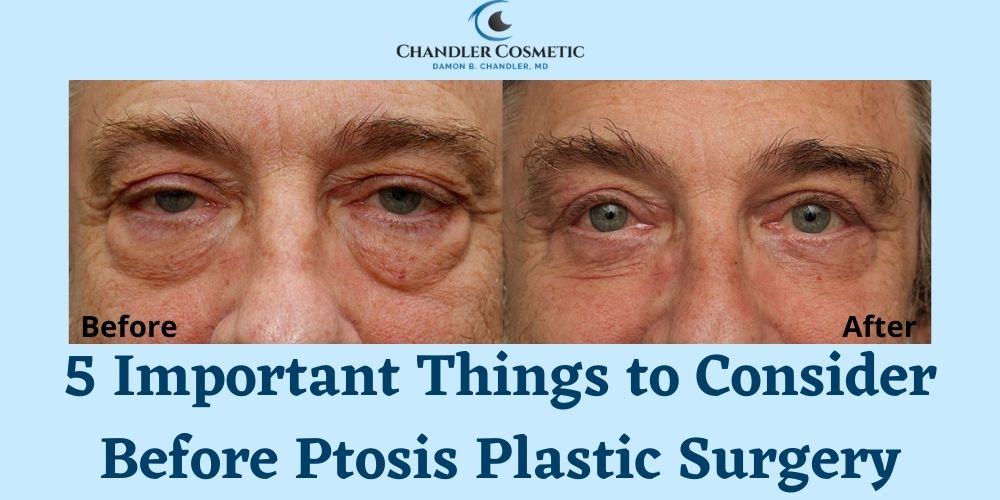 Ptosis Plastic Surgery