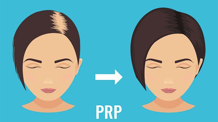 PRP-popular-way-to-treat-hair-loss