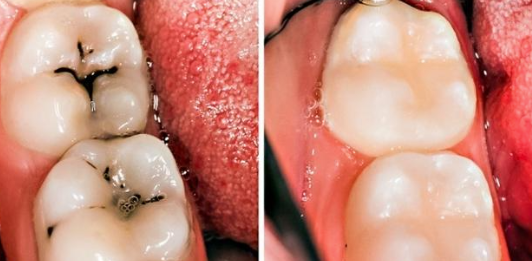 How to Stop Tooth Decay : Best 5 Daily Dental Care Tips by Howtostoptoothdecay - Ourboox.com