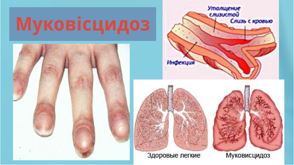 Скринінг-програми для новонароджених. by Olga - Ourboox.com