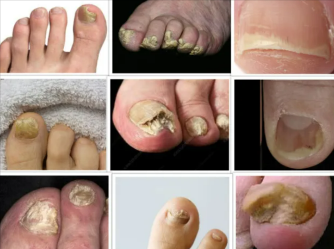 Best 5 Home Remedies for Toenail Fungus by Toenailfungus - Ourboox.com
