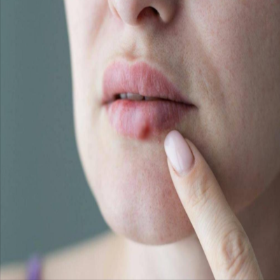 Herpesyl Reviews – Is It Safe To Use and Effective? by Herpesyl Reviews - Ourboox.com