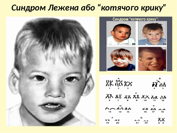 Хромосомні хвороби “Синдром котячого крику” by Volkotrub - Illustrated by Підготувала учениця 10-А класу Волкотруб Софія - Ourboox.com
