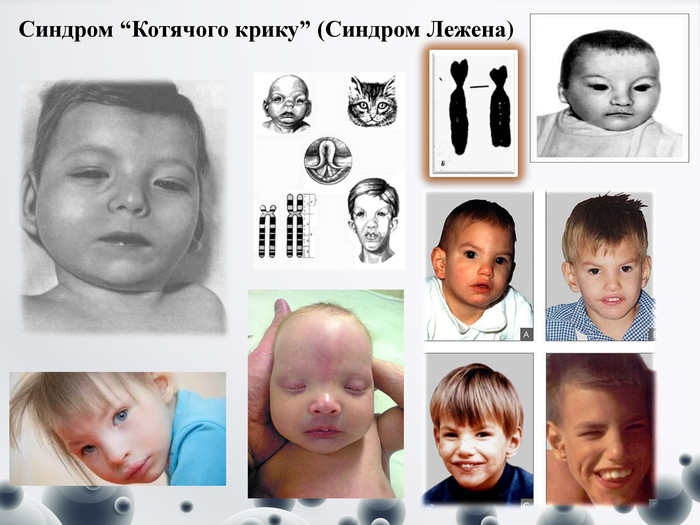 Хромосомні хвороби “Синдром котячого крику” by Volkotrub - Illustrated by Підготувала учениця 10-А класу Волкотруб Софія - Ourboox.com