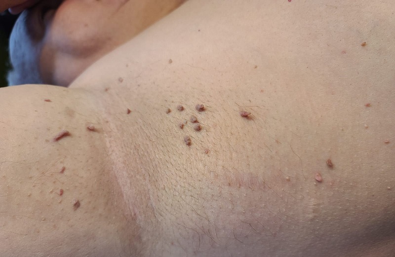 أشكال الزوائد الجلدية في الجسم وكيفية تمييزها